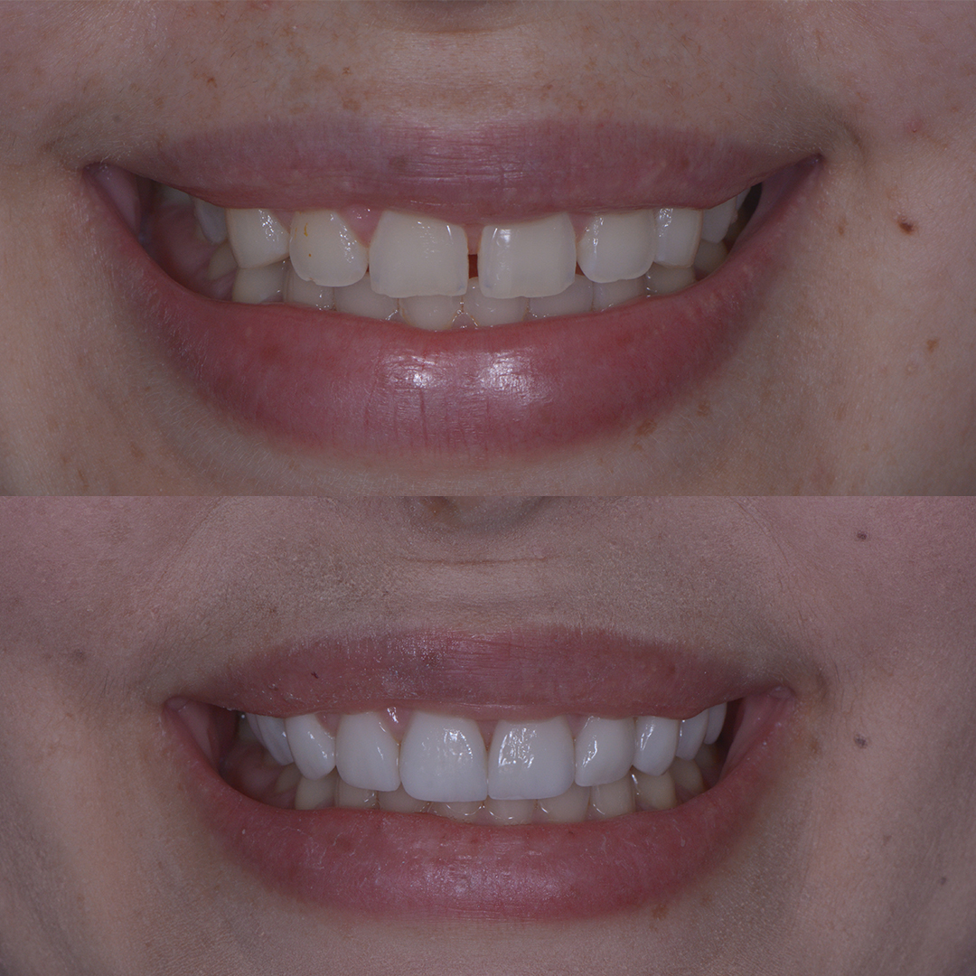 Antes x Depois - Lentes de Contato_0000_Camila Honda - Antes x Depois 2