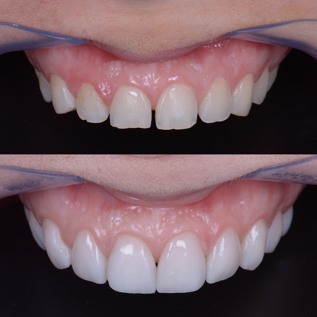 Antes x Depois - Lentes de Contato_0001_Camila Honda - Antes x Depois