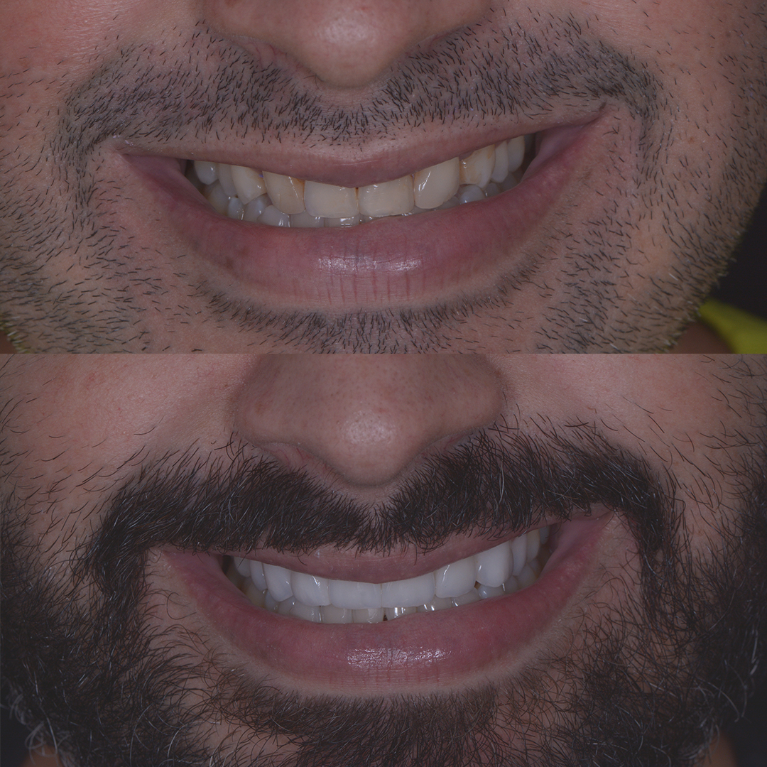 Antes x Depois - Lentes de Contato_0002_Rafael Pesco - Antes x Depois 2