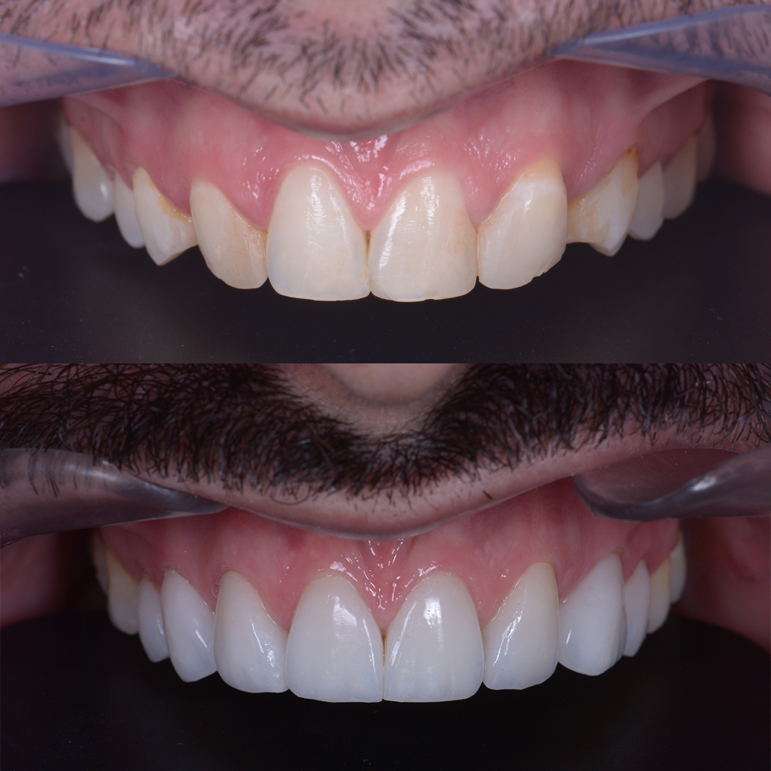 Antes x Depois - Lentes de Contato_0003_Rafael Pesco - Antes x Depois