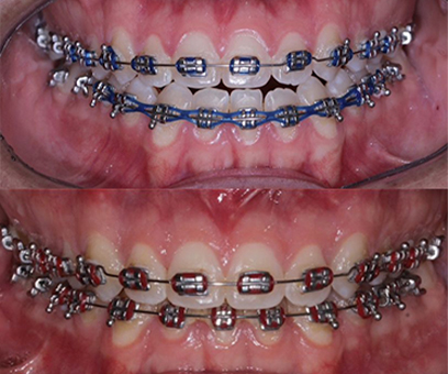 Antes x Depois 2_0000_Oclusão copiar