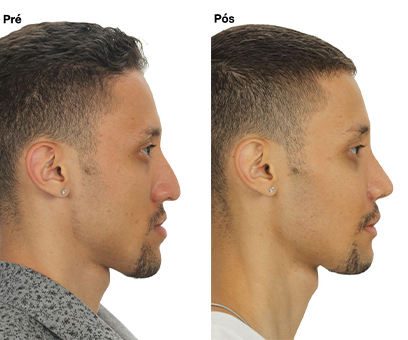 Antes x Depois 2_0001_Perfil copiar