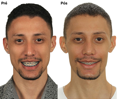 Antes x Depois 2_0002_Sorrindo copiar