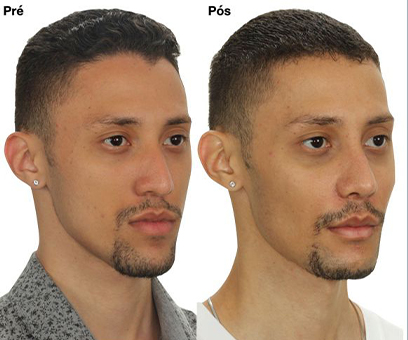 Antes x Depois 2_0003_De lado