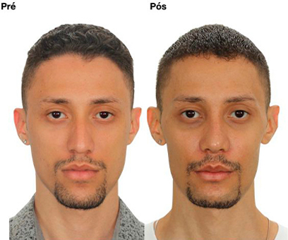 Antes x Depois 2_0004_Frente